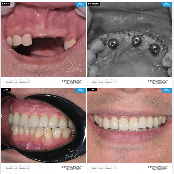 CA LÂM SÀNG IMPLANT  PHỤC HÌNH TỨC THÌ & KẾT QUẢ SAU 7 NGÀY