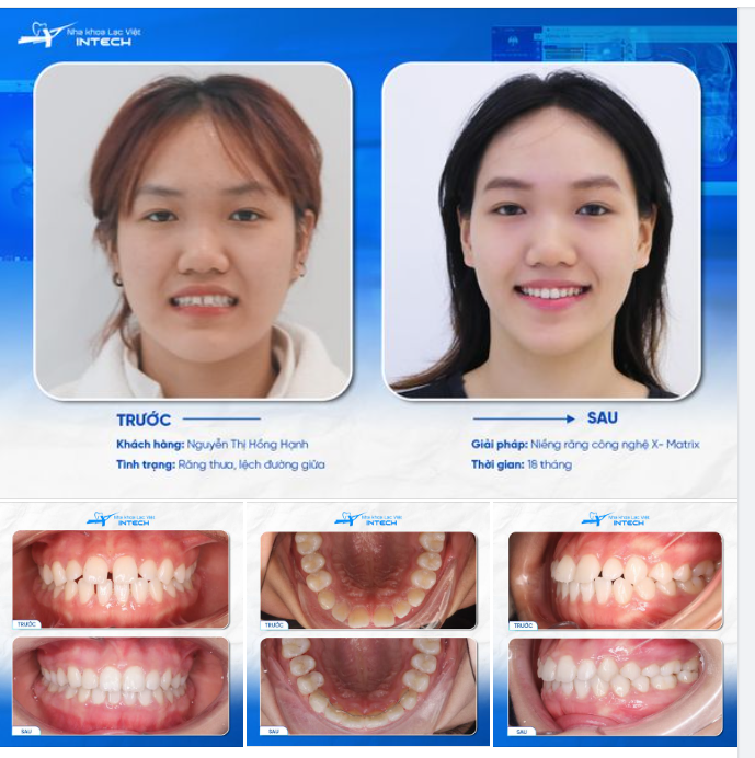 20 NĂM SỐNG CÙNG HÀM RĂNG THƯA “GIÓ LÙA”, CÔ GÁI NIỀNG RĂNG ĐỂ “ĐỔI VẬN”