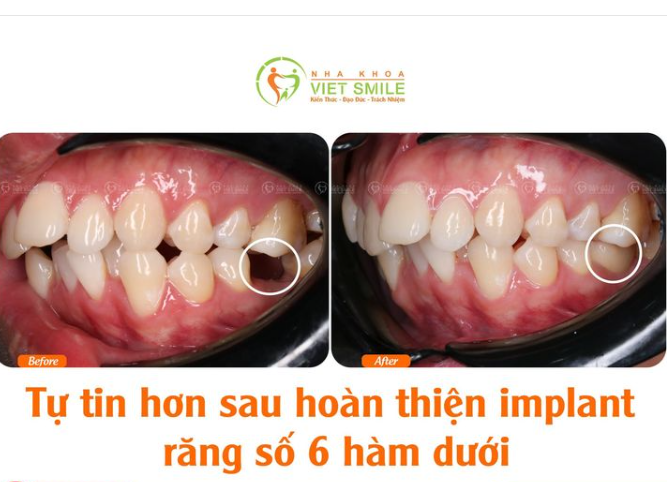 TỰ TIN HƠN SAU HOÀN THIỆN IMPLANT RĂNG SỐ 6 HÀM DƯỚI