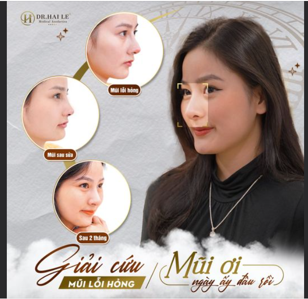 Đó là chia sẻ của bạn khách sau 2 tháng tham gia chương trình giải cứu mũi lỗi hỏng “mũi ơi ngày ấy đâu rồi” của Dr.Hải Lê.