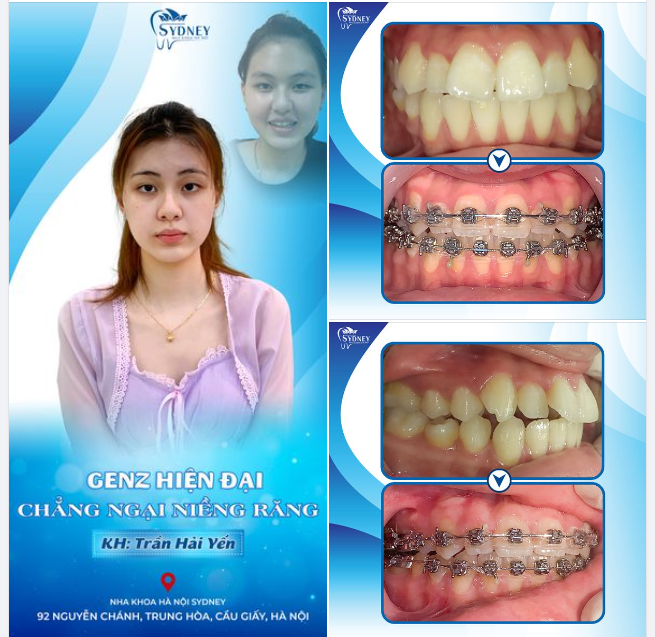 GENZ HIỆN ĐẠI - CHẲNG NGẠI NIỀNG RĂNG