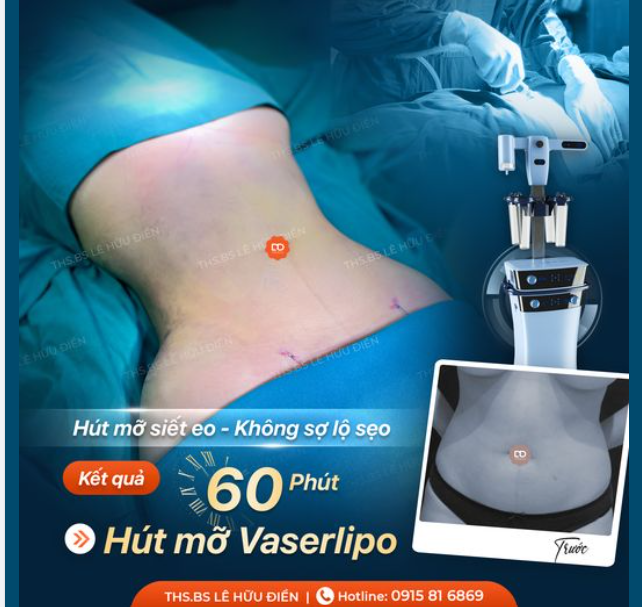 SIẾT CƠ THON GỌN - KHÔNG CÒN MỠ THỪA
