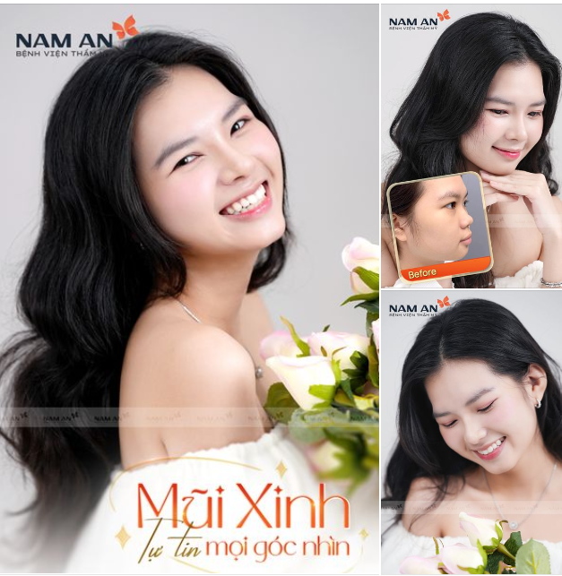 MŨI XINH TỰ TIN MỌI GÓC NHÌN