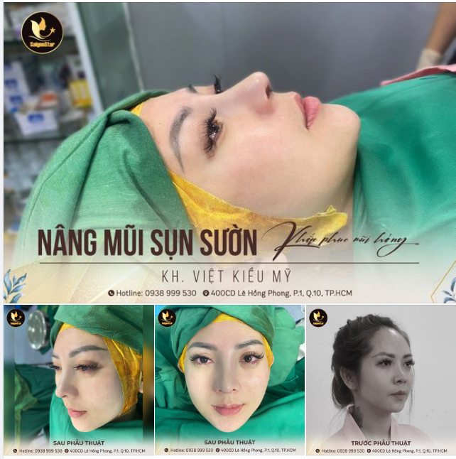 NÂNG MŨI SỤN SƯỜN – XÓA SẠCH DẤU VẾT MŨI HỎNG