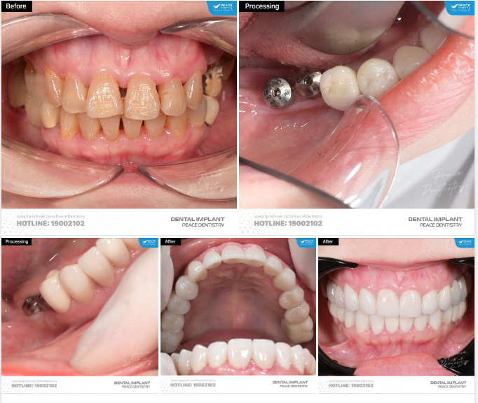 Ca implant & thẩm mỹ răng sứ cho chị khách hàng trung niên với mong muốn nụ cười đẹp tự nhiên