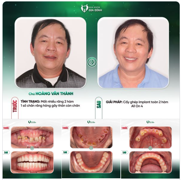 TRỒNG RĂNG TOÀN HÀM THỎA MÃN KỲ VỌNG ĂN NGON, SỐNG KHỎE CỦA NGƯỜI LỚN TUỔI