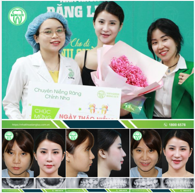 TỐT NGHIỆP NIỀNG RĂNG