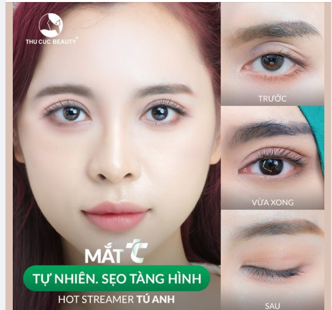 Cắt mí TC đẹp tự nhiên sẹo tàng hình
