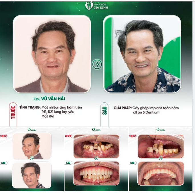 VƯỢT QUA NỖI SỢ TRỒNG RĂNG, ĐÓN NHẬN NỤ CƯỜI MƠ ƯỚC BẤY LÂU