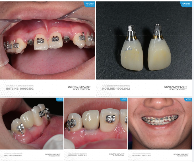 CA LÂM SÀNG ĐIỀU TRỊ  LIÊN CHUYÊN KHOA CHỈNH NHA & IMPLANT