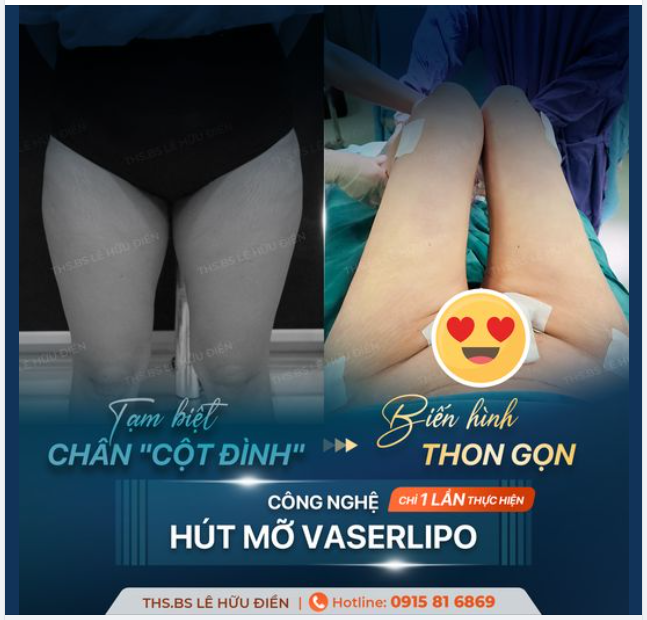 Tạm biệt chân cột đình - biến hình thon gọn. Sự khác biệt trước và sau 90 phút thực hiện hút mỡ công nghệ Vaserlipo.