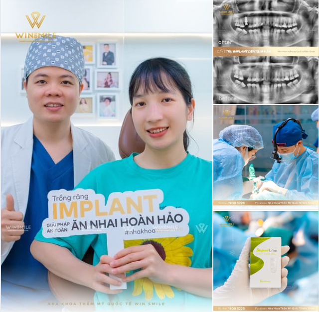 MẤT KHOẢNG PHỤC HÌNH IMPLANT - HỆ QUẢ CỦA MẤT RĂNG LÂU NGÀY