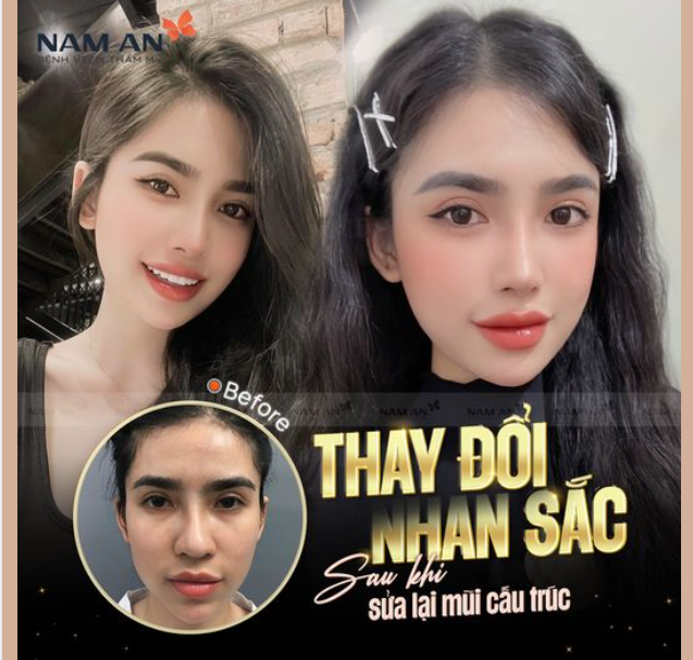 THAY ĐỔI NHAN SẮC SAU NÂNG MŨI SỬA LẠI
