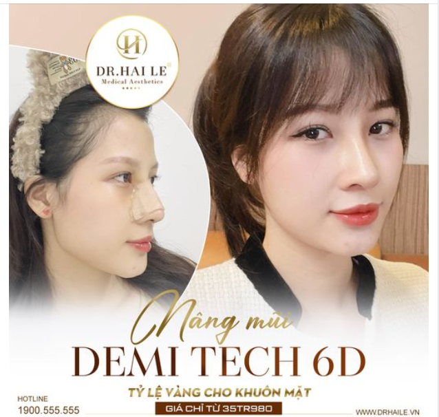 Nâng mũi Demi Tech 6D - Tỷ lệ vàng cho khuôn mặt