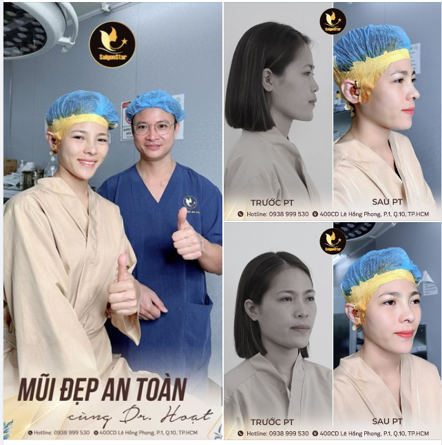 Cùng SAIGON STAR nạp năng lượng xinh đẹp cho cuối tuần - Với dáng mũi siêu nét sau 60 phút nâng mũi cấu trúc 