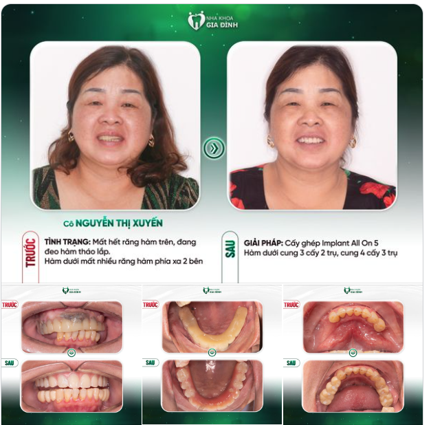 MỘT HÀM RĂNG KHỎE MẠNH - MÓN QUÀ VÔ GIÁ GỬI TẶNG NGƯỜI THÂN
