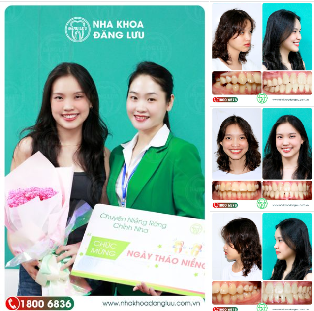 TỐT NGHIỆP NIỀNG RĂNG