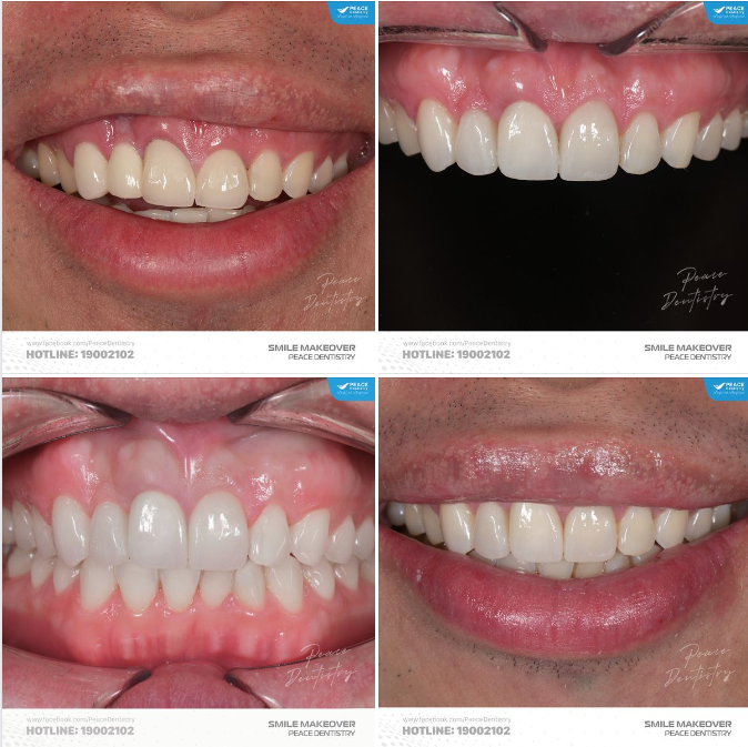 PHẪU THUẬT CƯỜI HỞ LỢI: GIẢI ĐÁP NHANH 7 CÂU HỎI PHỔ BIẾN TỪ KHÁCH HÀNG
