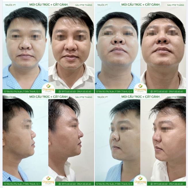 Đây là một ví dụ tuyệt vời cho việc cánh mày râu vẫn có thể thực hiện nâng mũi và đẹp là đằng khác