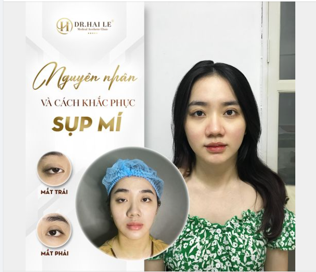 Sụp mí thường là do bẩm sinh, khi cơ nâng mí mắt trên bị liệt hoặc yếu do nhiều nguyên nhân.