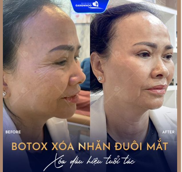 TIÊM BOTOX XÓA NHĂN ĐUÔI MẮT