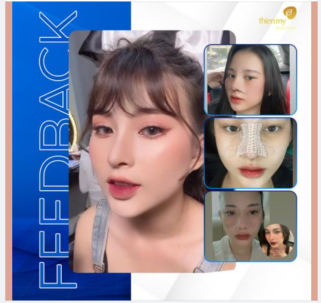 Hành trình nâng mũi tại PKCK Thiện Mỹ
