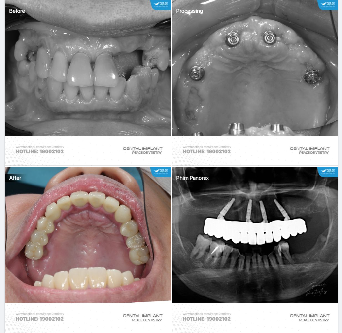 CẤY GHÉP IMPLANT TỨC THÌ & PHỤC HÌNH TỨC THÌ: