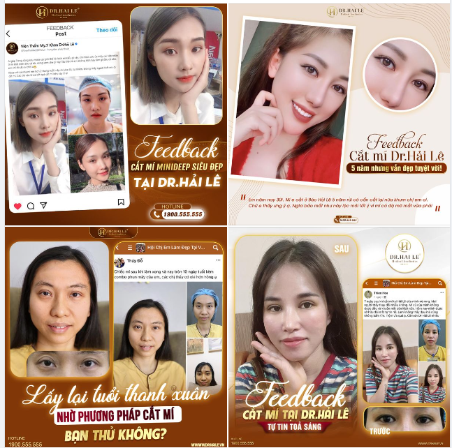 MẮT HAI MÍ - XINH NHƯ Ý 