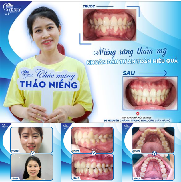 NIỀNG RĂNG THẨM MỸ - KHOẢN ĐẦU TƯ AN TOÀN HIỆU QUẢ