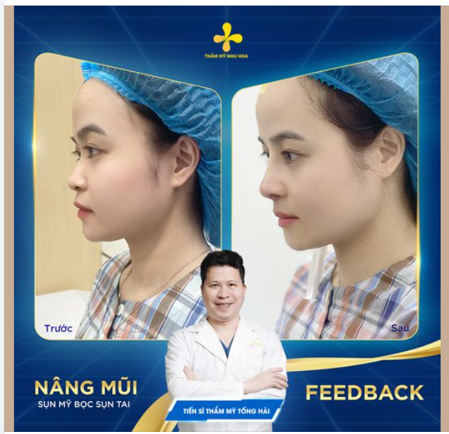 Kết quả ngay sau nâng mũi cho bạn Trần Thảo đến từ Thái Nguyên.