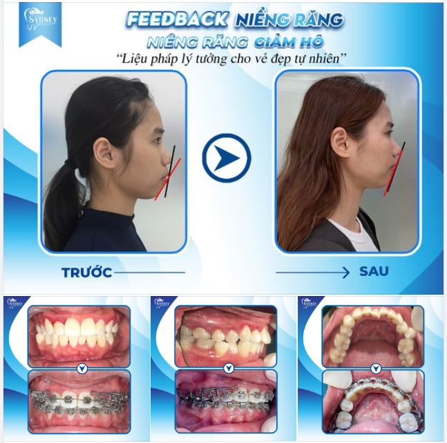 NIỀNG RĂNG GIẢM HÔ - LIỆU PHÁP LÝ TƯỞNG CHO VẺ ĐẸP TỰ TIN