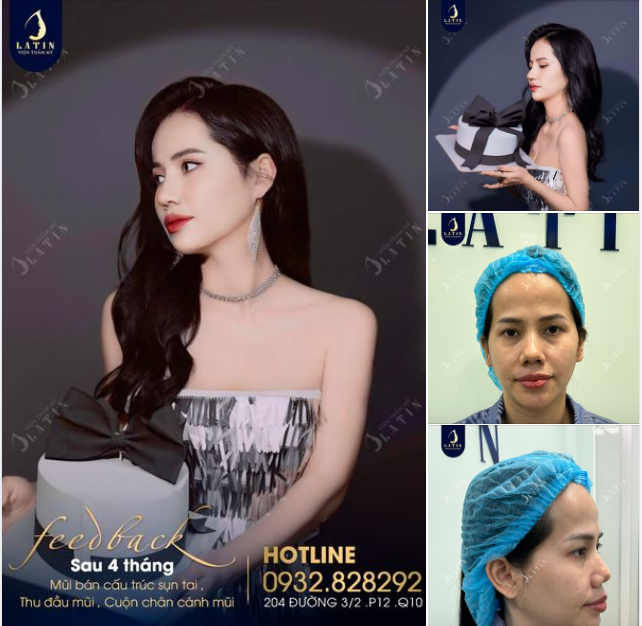 Feedback mũi bán cấu trúc 4 tháng từ khách yêu