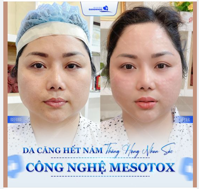 CÔNG NGHỆ MESOTOX Da căng bóng hết nám da thăng hạng nhan sắc 