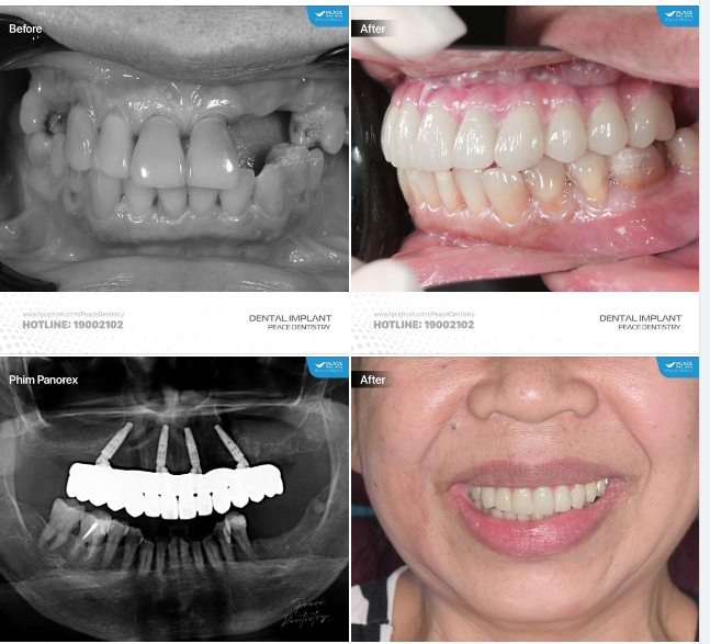 VÌ SAO BÁC SĨ KHUYÊN NÊN SỚM TRỒNG RĂNG IMPLANT KHI MẤT RĂNG? (xem thêm Ưu Đãi Đặc Biệt ở bình luận)