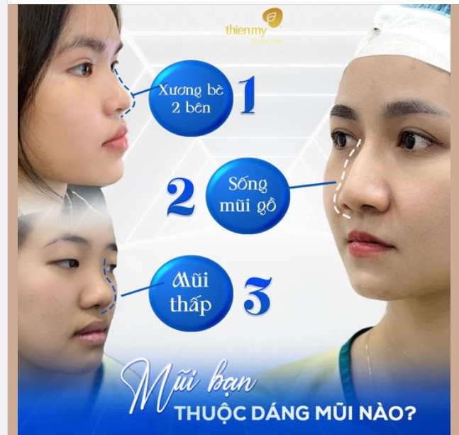 Bạn thuộc mũi hếch, mũi gồ hay mũi thấp?
