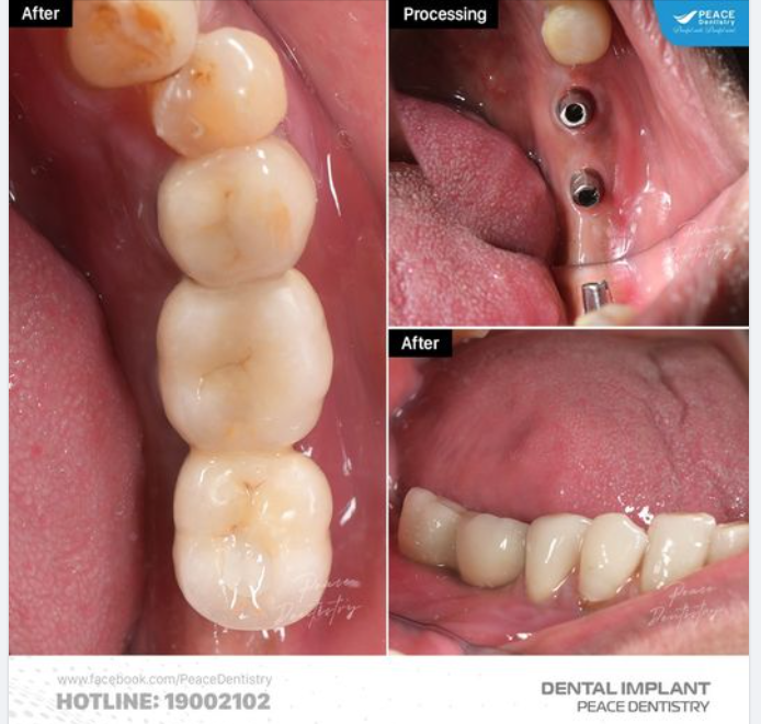 CẬN CẢNH SAU KHI PHỤC HÌNH RĂNG TRÊN IMPLANT