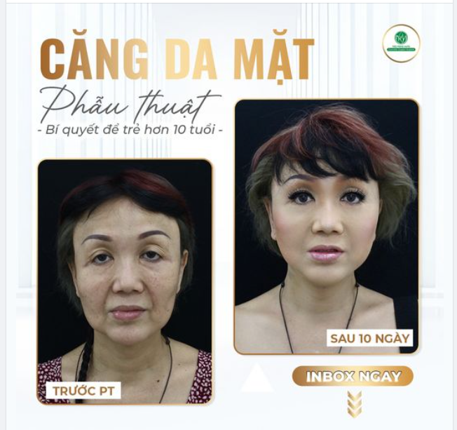 MỘT TRONG NHỮNG CA PT CĂNG DA MẶT THÀNH CÔNG NHẤT TẠI BV