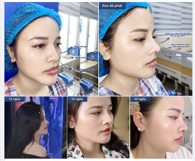 SỞ HỮU DÁNG MŨI TRẺ LÂU NHƯ CHỦ SPA ĐẾN TỪ QUẢNG NINH