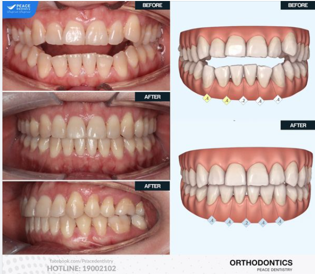 Ca lâm sàng: Niềng răng Invisalign cho tình trạng khớp cắn hở, chen chúc và lệch đường giữa. Hoàn thành sau 18 tháng.