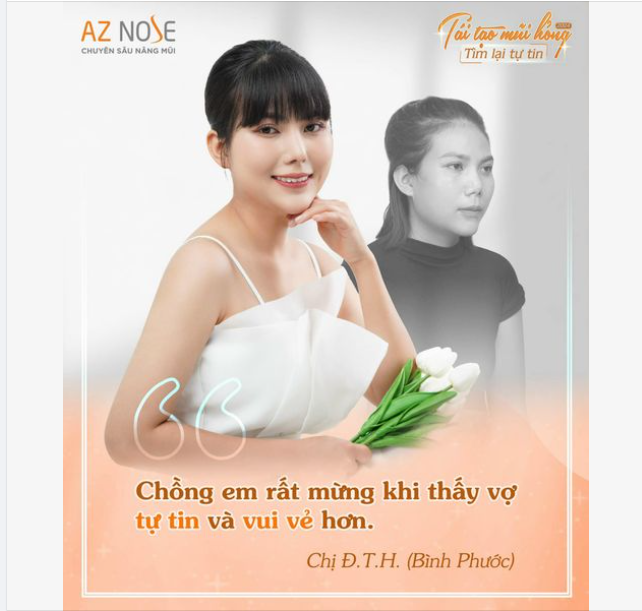 Tìm lại tự tin sau 5tháng tái tạo dáng mũi bởi bác sĩ CKI. Đinh Xuân Sơn Tùng