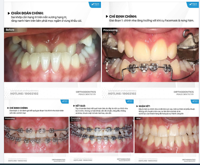 CA LÂM SÀNG CHỈNH NHA ĐẶC BIỆT PHỨC TẠP, THIÊN VỀ PHẪU THUẬT