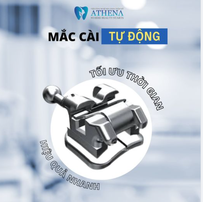 Niềng Răng Nhanh Chóng và Hiệu Quả với Mắc Cài Tự Động