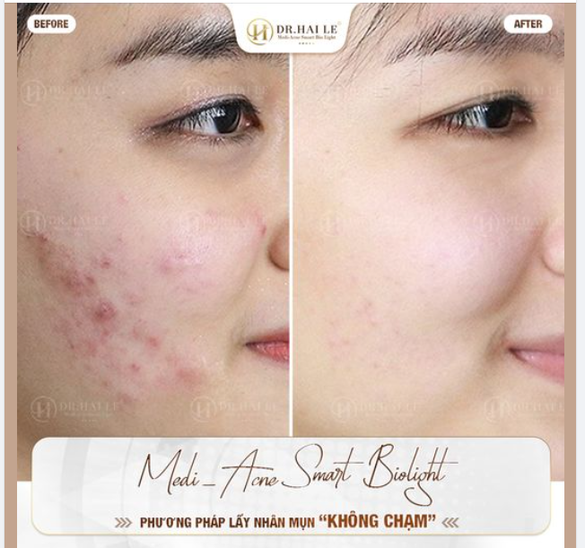 Tổ hợp công nghệ Medi-Acne Smart Bio Light đã thành công trị mụn cho 30.000 khách hàng tại Dr.Hải Lê.