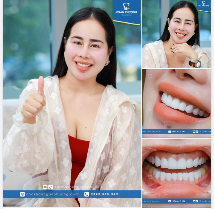 Răng sứ có ảnh hưởng khi sinh con, chăm sóc em bé không?