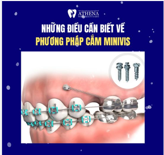 Cắm Minivis là gì ? Tại sao cắm Minivis lại cần thiết khi chỉnh nha?