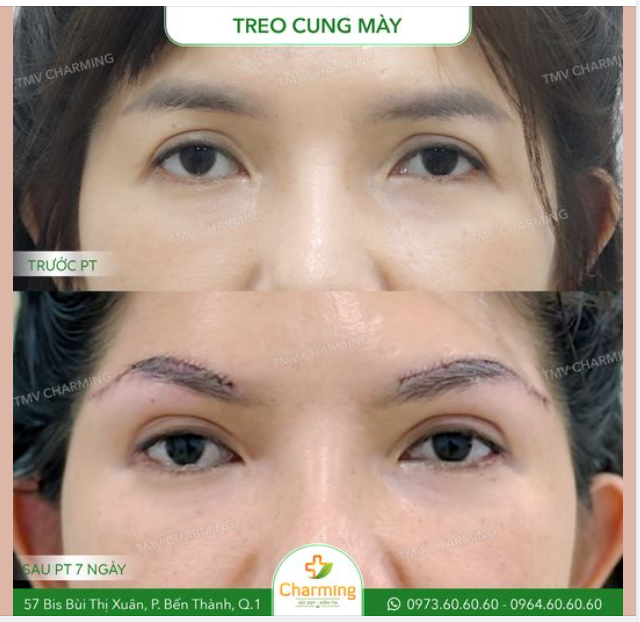 Mọi người có tin gương mặt có thể trẻ liền ra nhiều tuổi chỉ với phương pháp treo cung mày không?