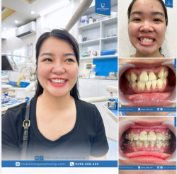 Vẫn trong quá trình niềng nhưng răng bạn ấy đã thay đổi rất nhiều!