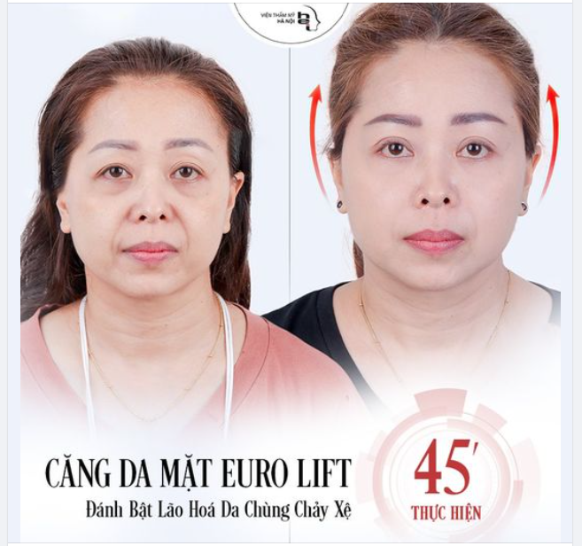 CĂNG DA MẶT NỘI SOI EURO LIFT - THỔI BAY LÃO HOÁ DA CHÙNG CHẢY XỆ