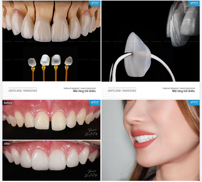 MỨC ĐỘ XỬ LÝ MEN RĂNG KHI LÀM MẶT DÁN SỨ VENEER: