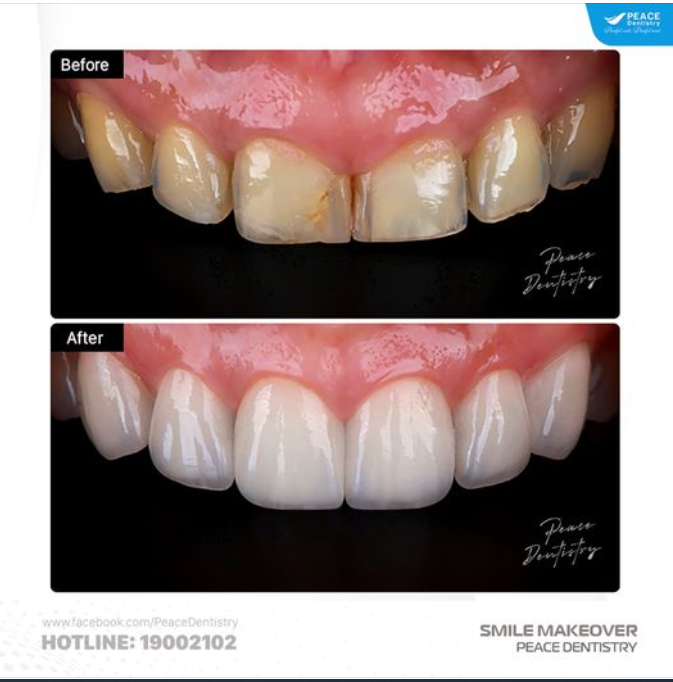 DÁN MẶT SỨ VENEER & PHÂN VÂN CỦA RẤT NHIỀU KHÁCH HÀNG: